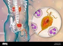 Remède pour soigner le Trichomonas vaginalis